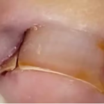 Unha Encravada: Causas, Sintomas e Tratamentos